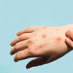 Manos con ampollas por viruela símica