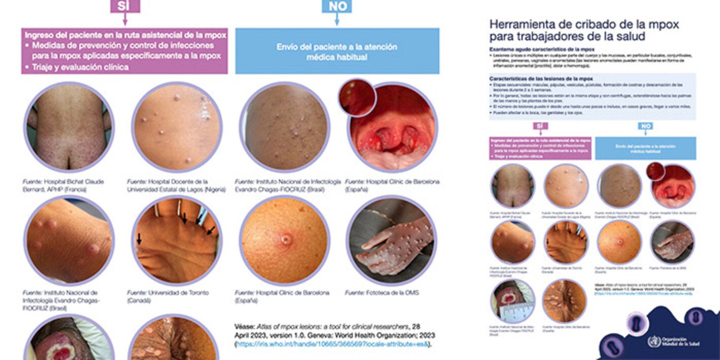 Herramienta cribado mpox